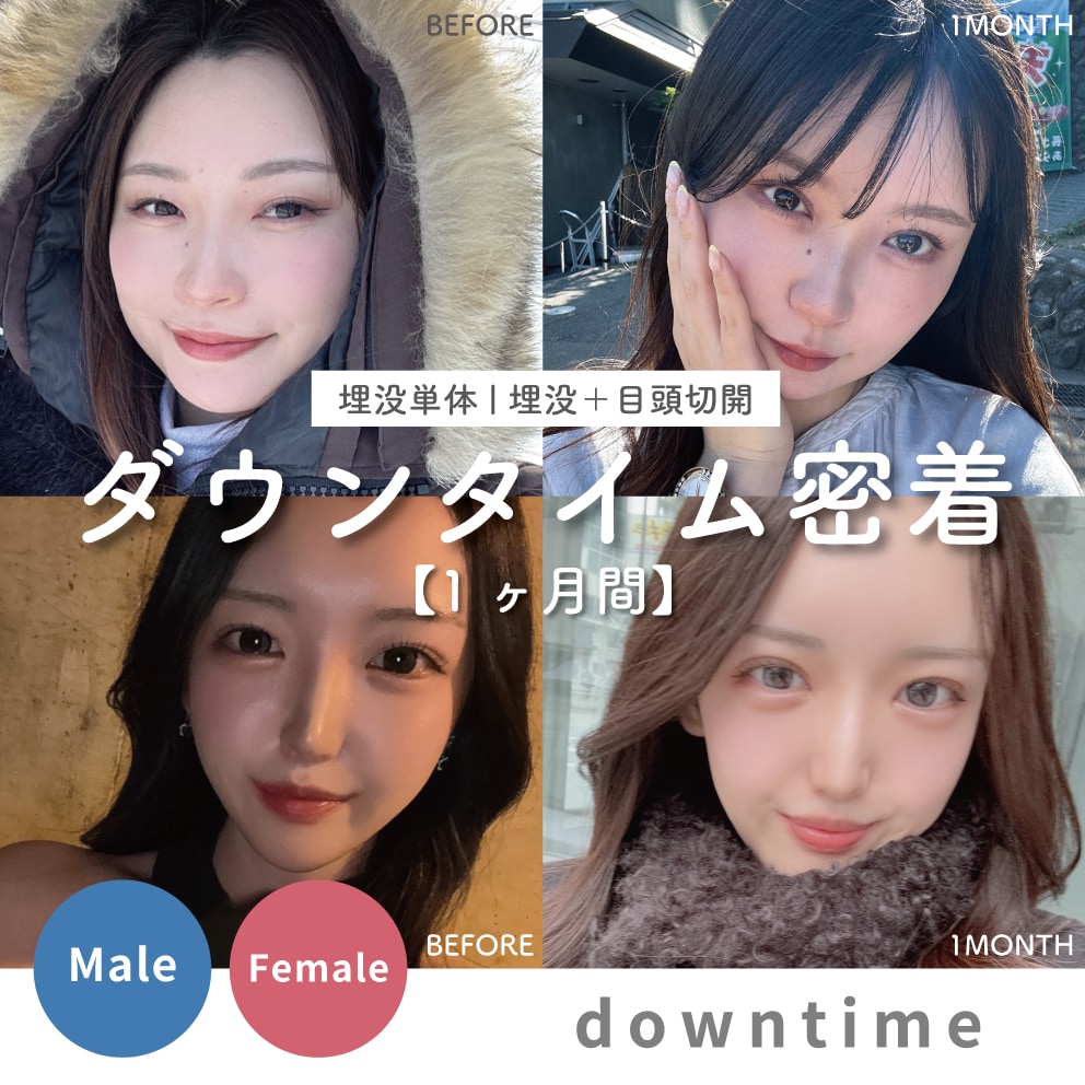 【1ヶ月間の密着】埋没ダウンタイム経過解説 | 埋没単体と目頭切開併用で内出血や腫れ感はどれくらい違う？徹底比較します。