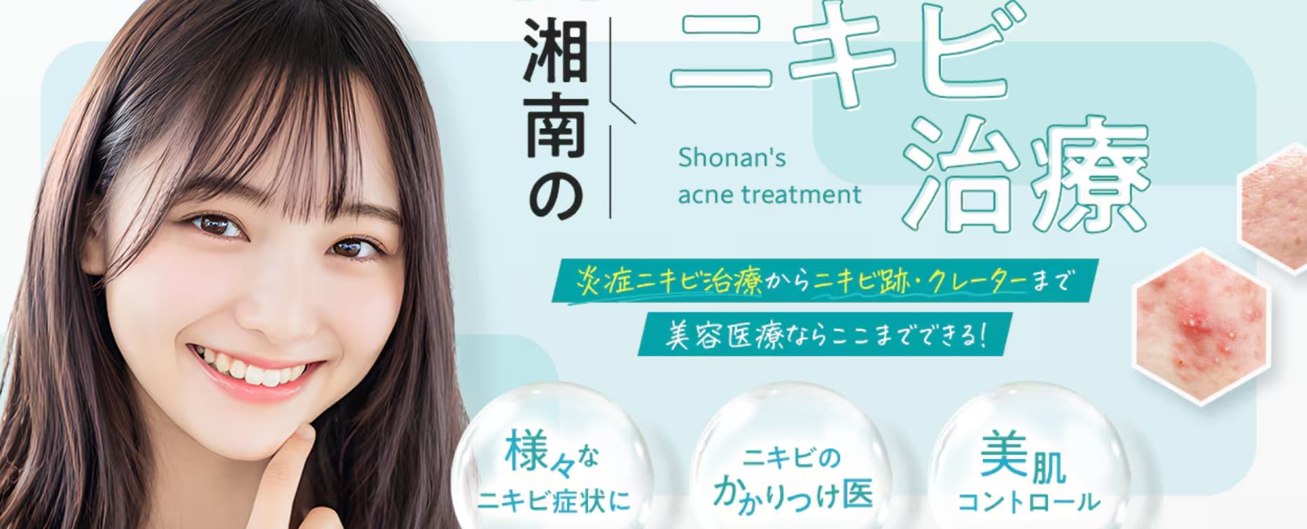 アクネ