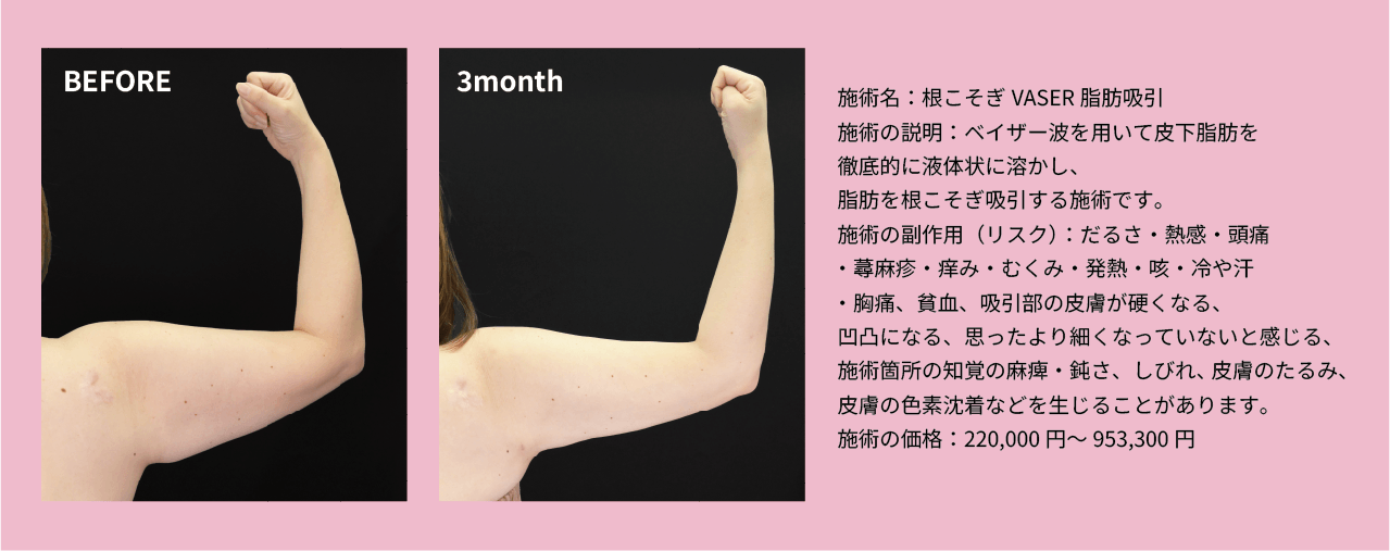 ベイザー