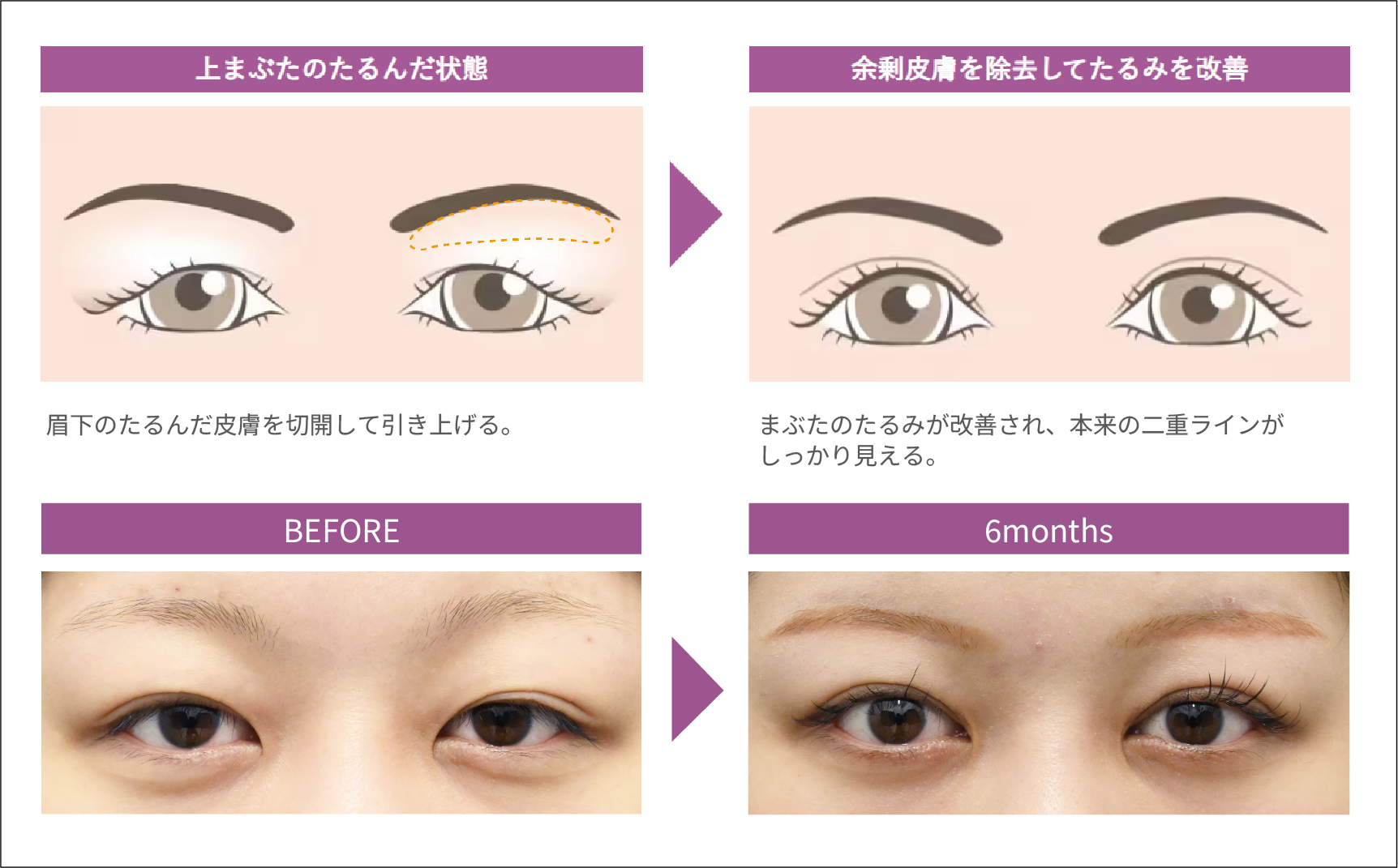 眉下切開とは