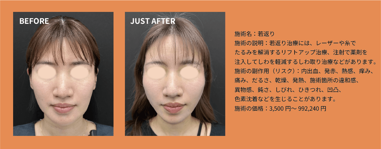 糸リフト