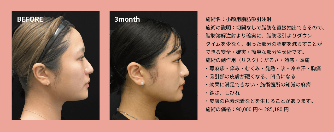 脂肪吸引注射