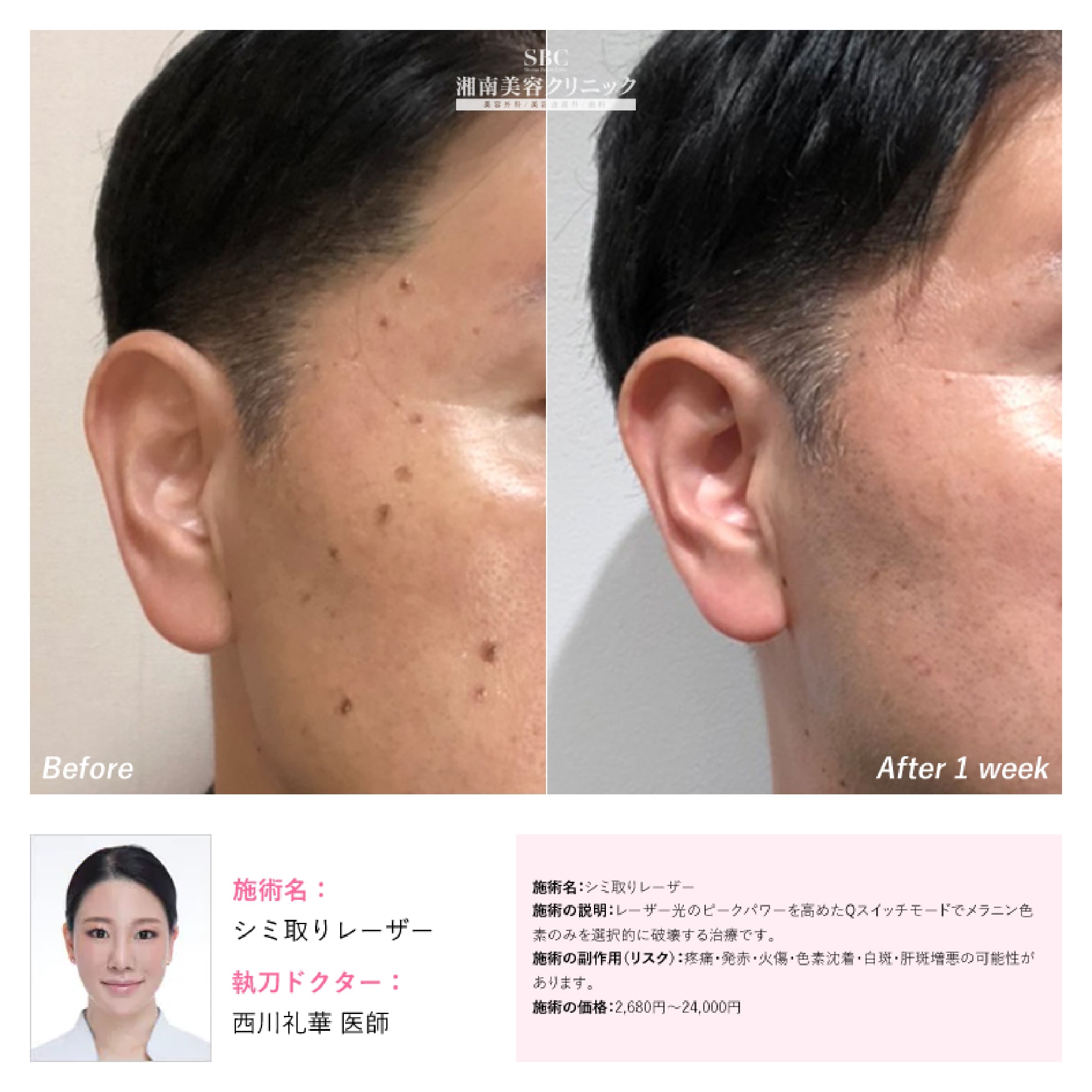 シミ取りレーザー 症例1