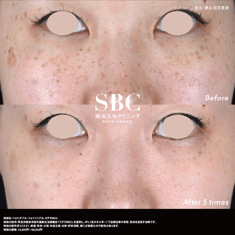 ステラM22症例