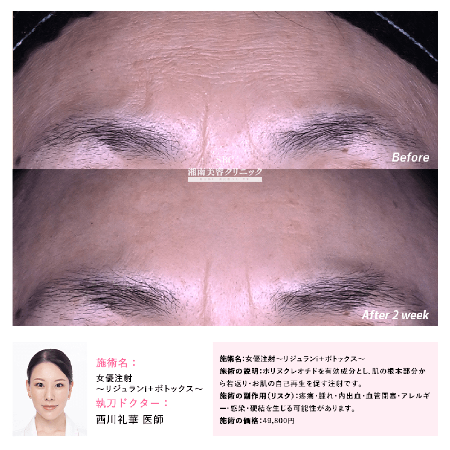 上野院 女優注射 症例写真