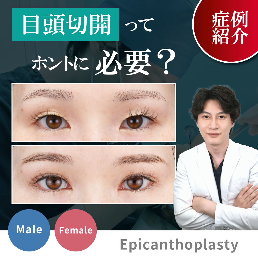 本当に目頭切開は必要？ | バレない目頭切開をするなら湘南美容クリニック上野院の院長にお任せください。