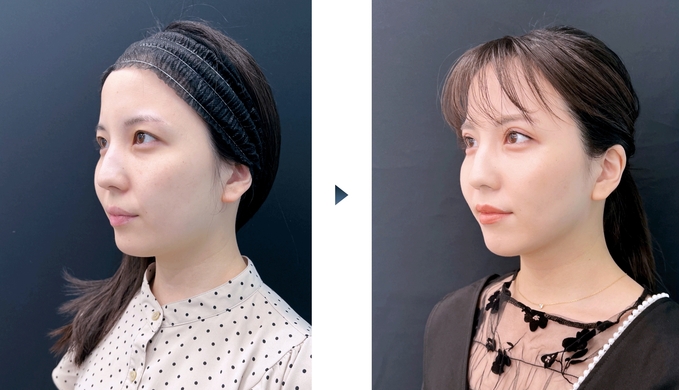 20代の脂肪吸引の症例