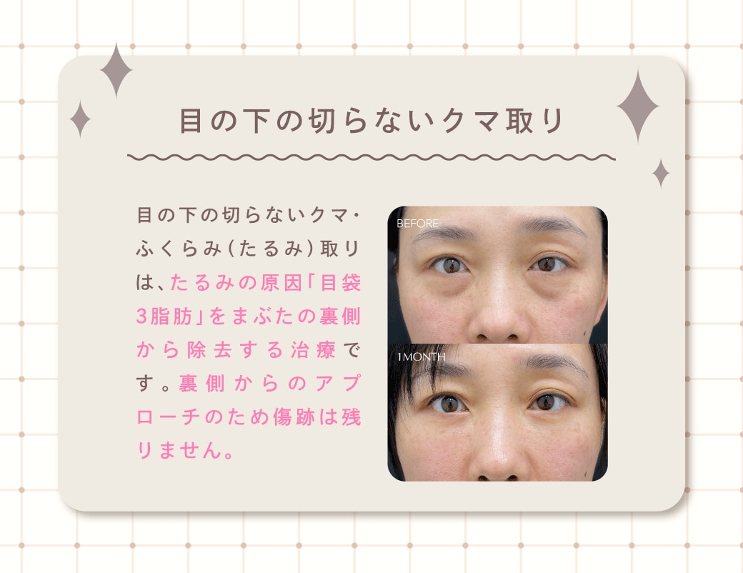 目の下の切らないクマとり