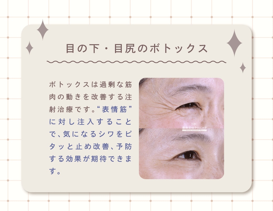 目の下・目尻のボトックス