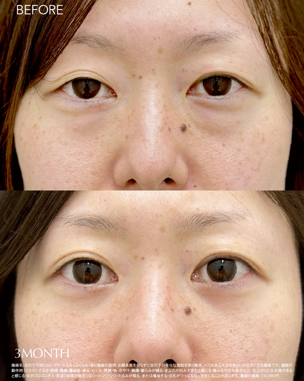 30代のくま取り症例