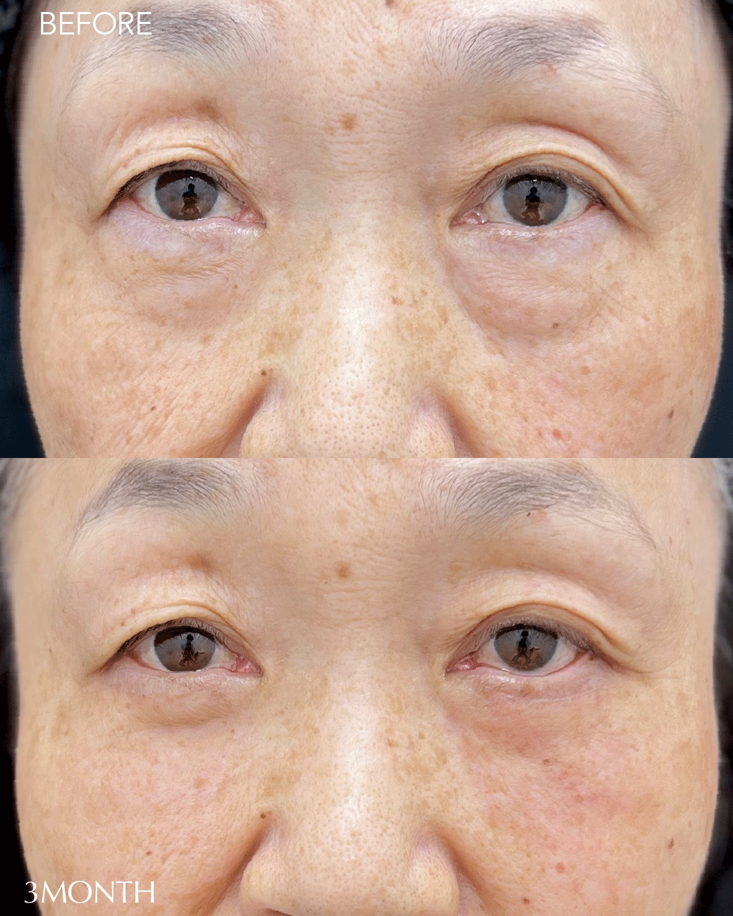 60代のくま取り症例