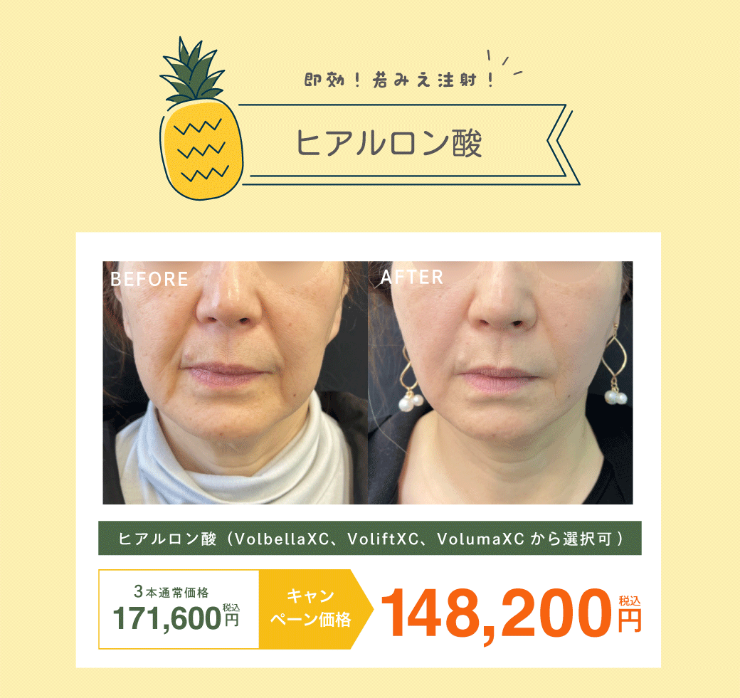 ヒアルロン酸