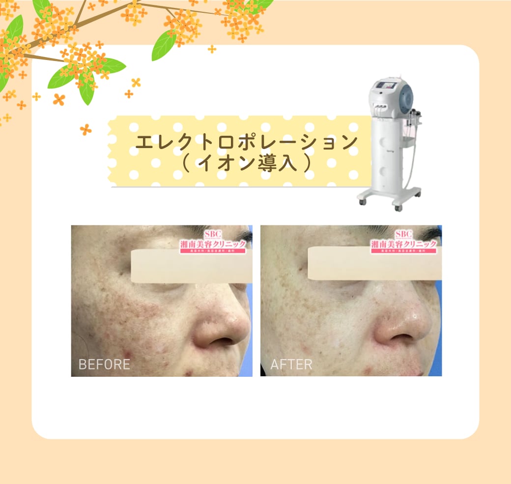 エレクトロポレーション(イオン導入)
