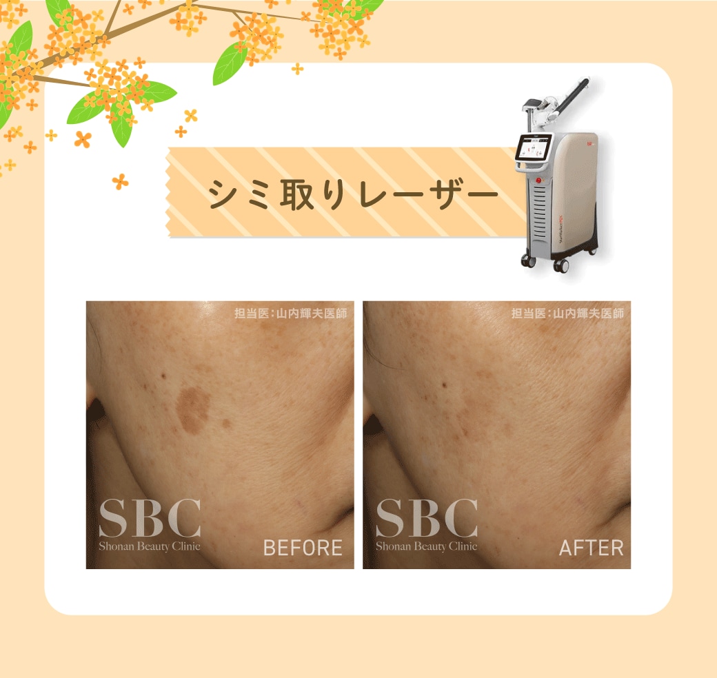 シミ取りレーザー