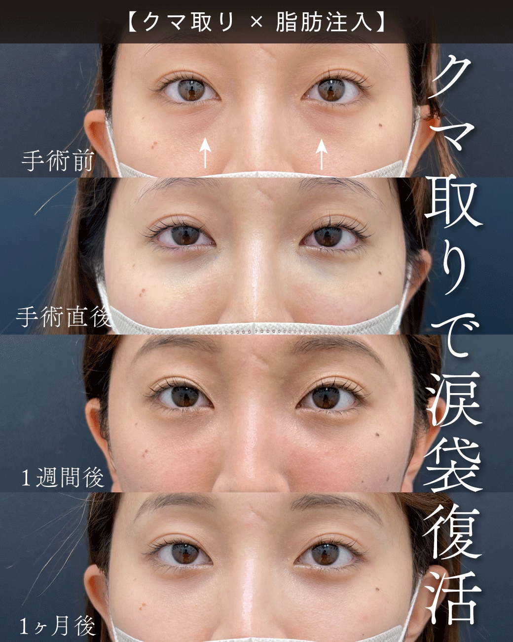 20代のくま取り症例