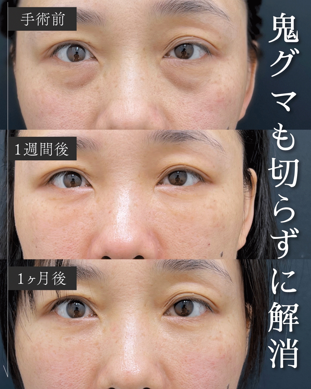 30代のくま取り症例