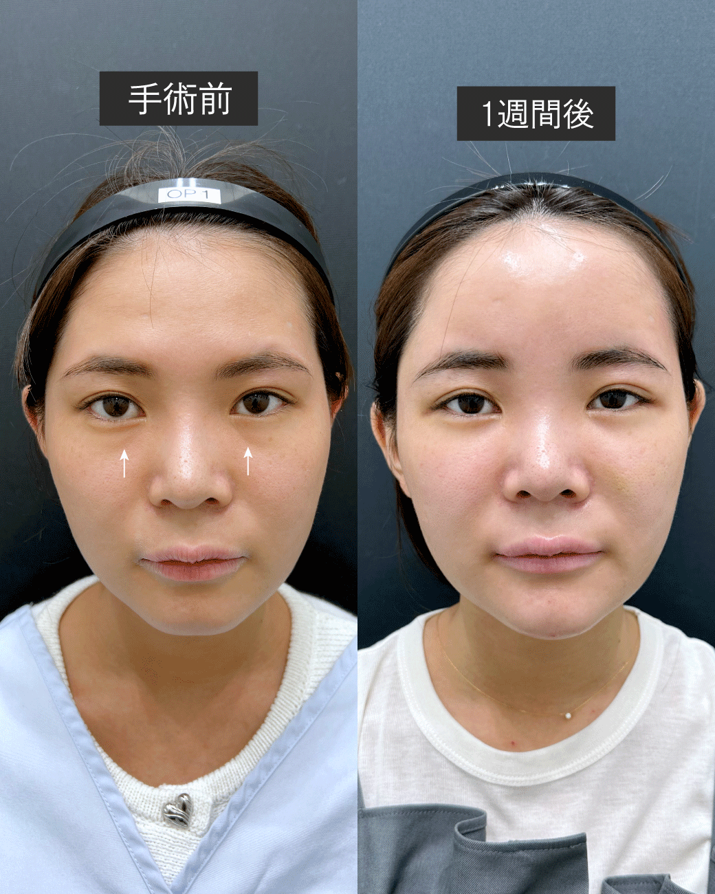 手術直後から2週間、見た目の変化と症状を解説