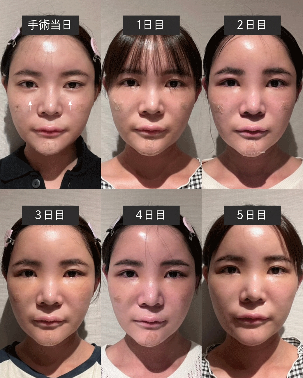 手術直後～翌日
