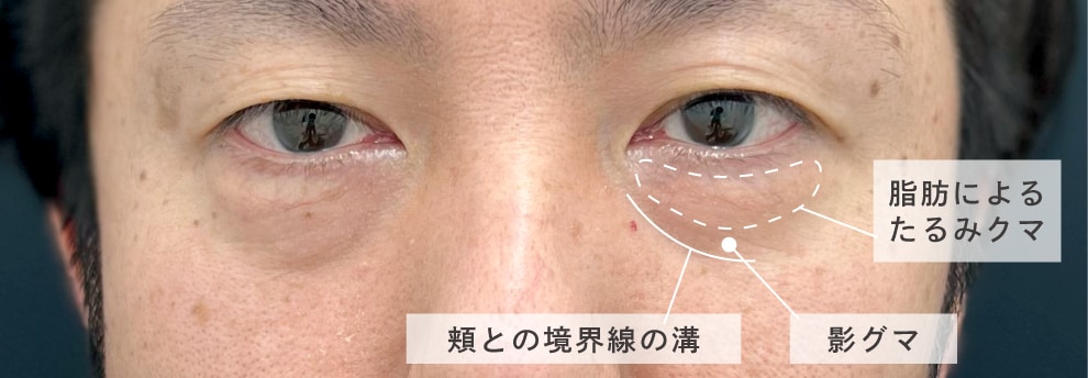 影クマ＋たるみクマの複合タイプ