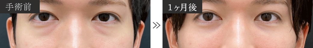 30代のくま取り症例