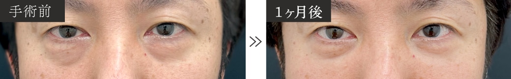 40代のくま取り症例