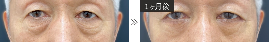 70代のくま取り症例