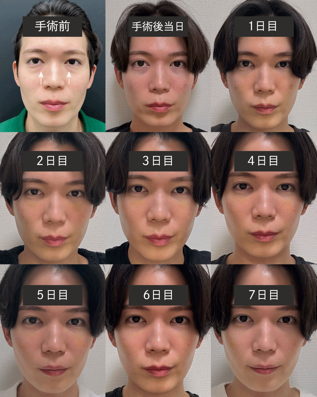 ダウンタイムはどのくらい？