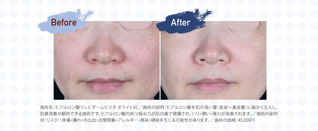 毛穴の引き締めや肌のハリ改善にもアプローチ