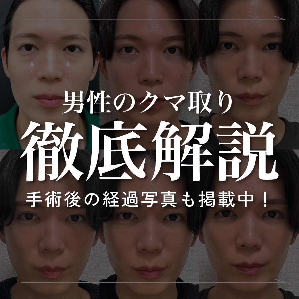 【男性のクマ取り｜埼玉・浦和】疲れて見える目元を、“自然に”アップデートする