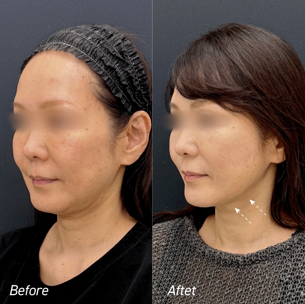 ただ上げるだけじゃない。かなやん流「デザインリフト」