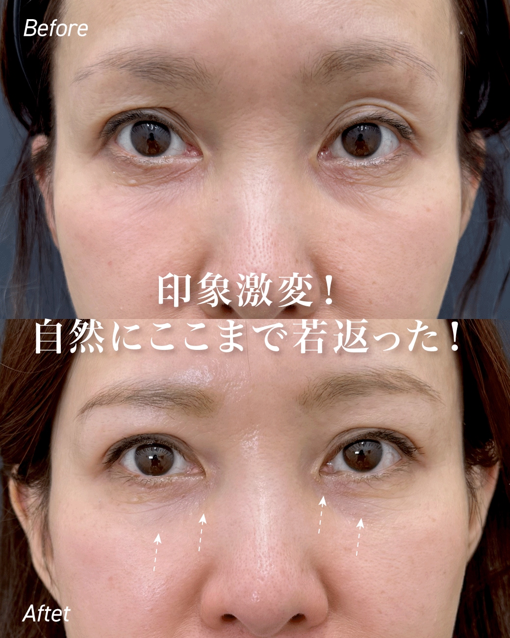 女優注射＆リジュラン。肌の内側から溢れる「ツヤ」