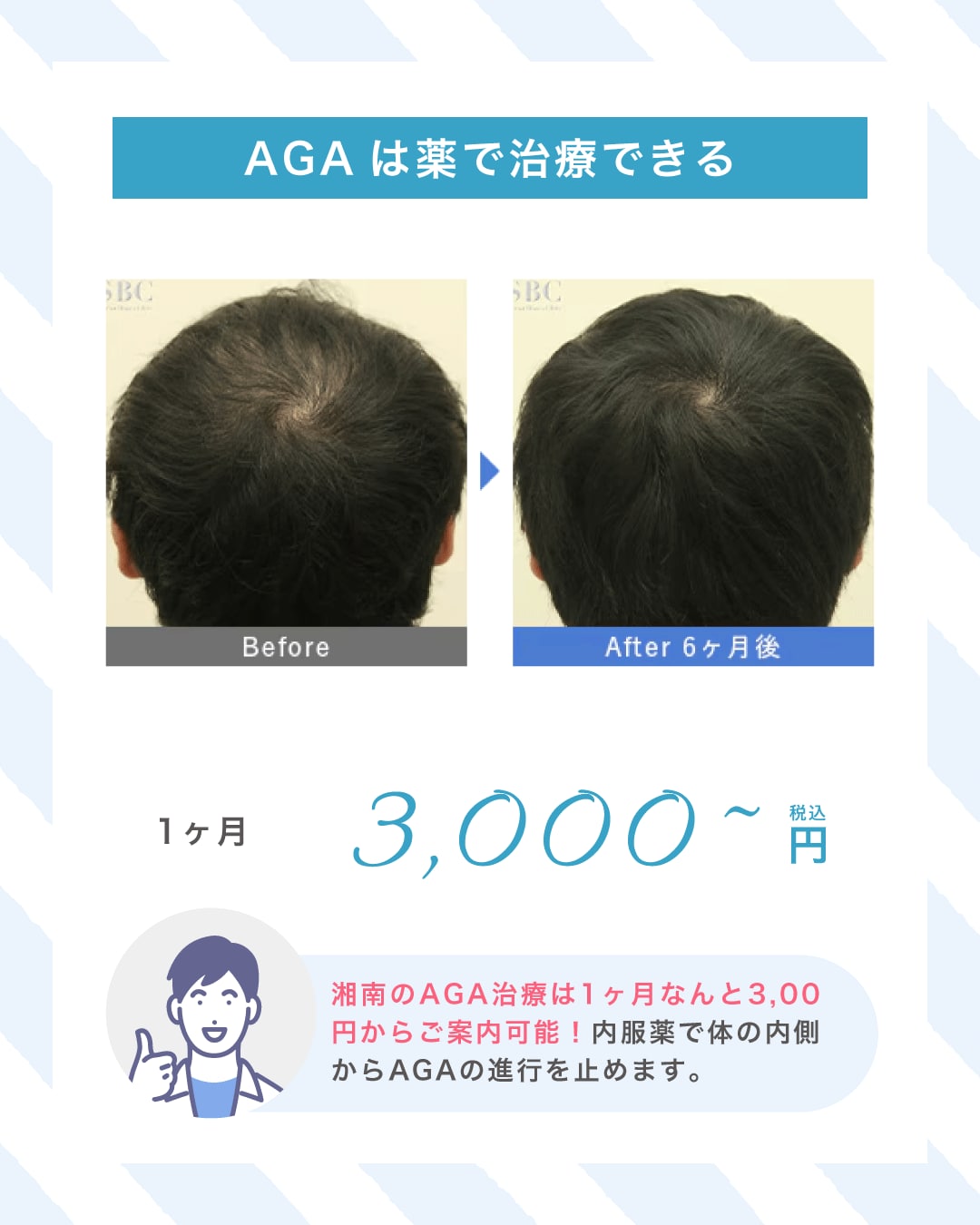 AGAは薬で治療できる