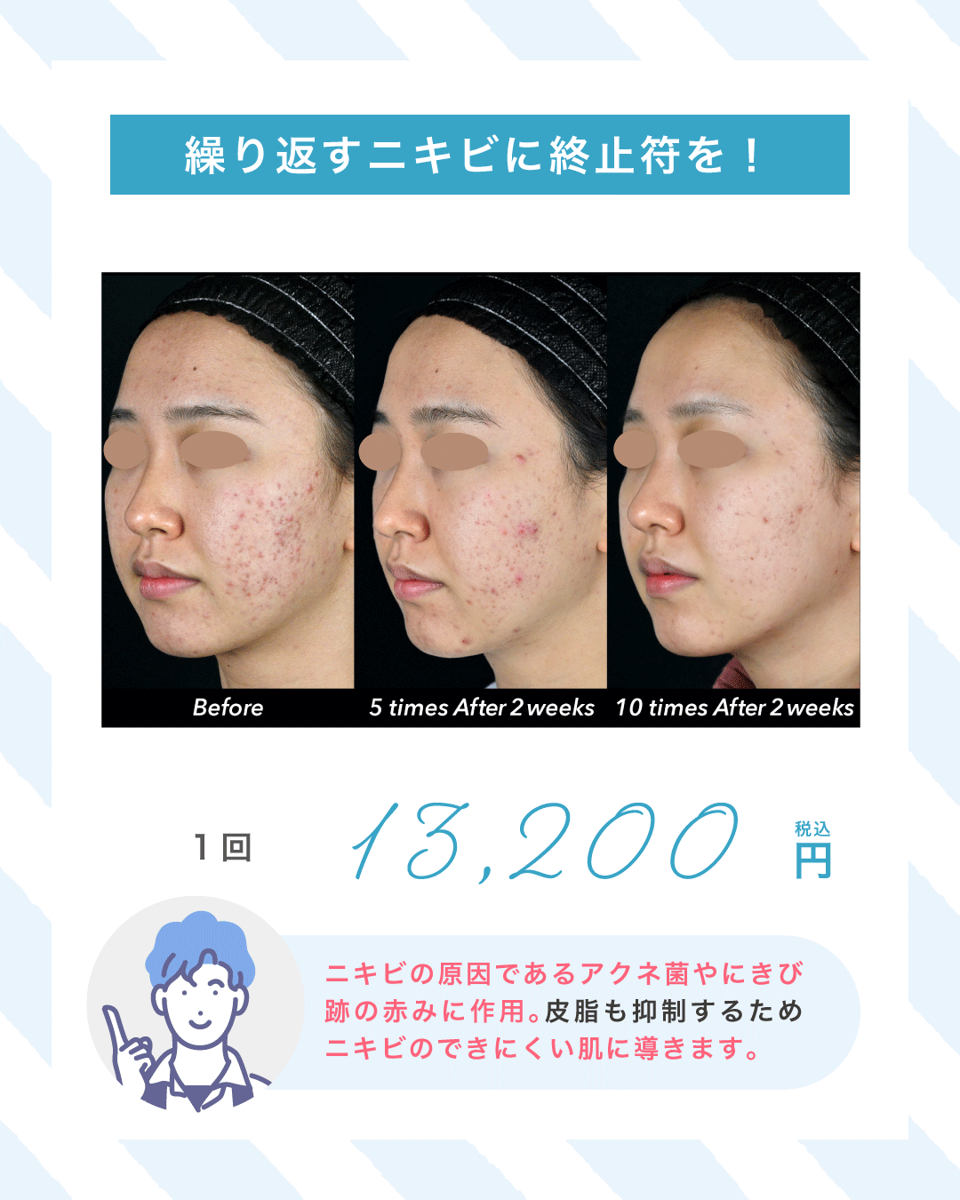 繰り返すニキビに終止符を！アクネライト