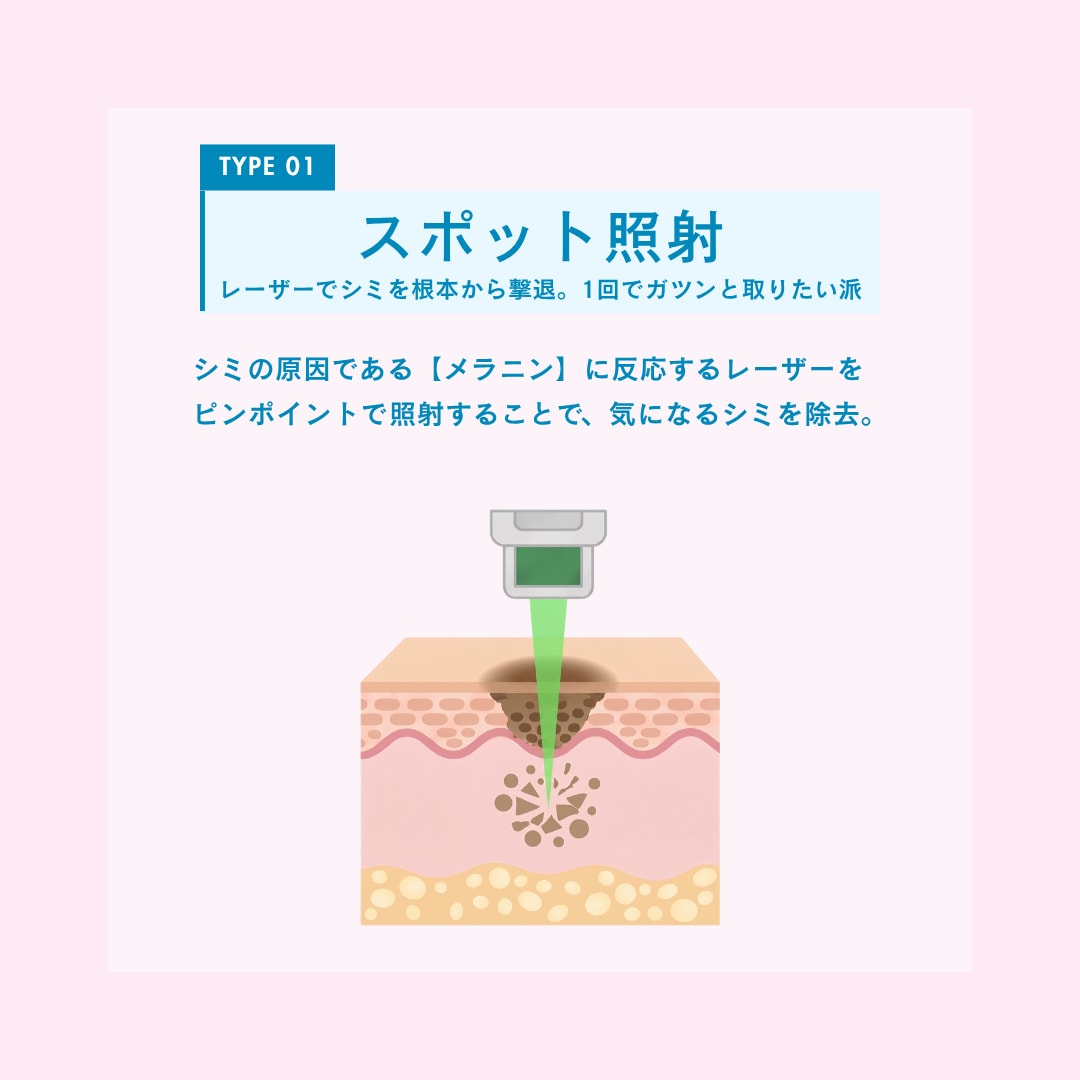 スポット照射
