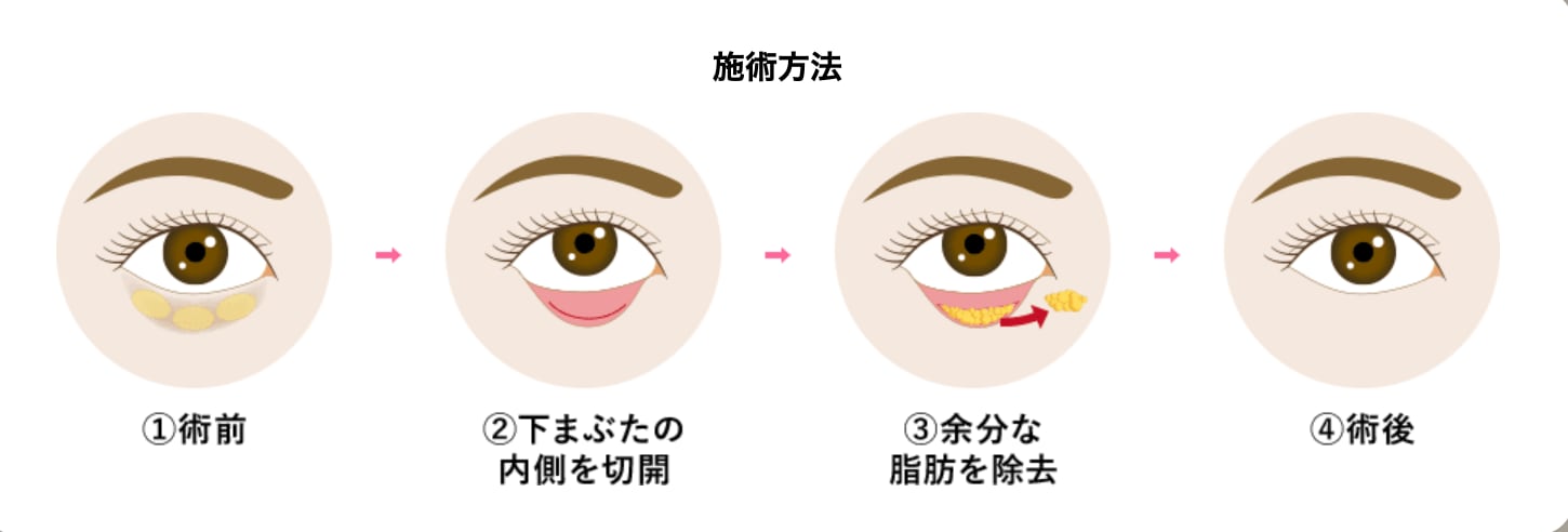 そもそも「クマ取り（経結膜脱脂法）」とは？