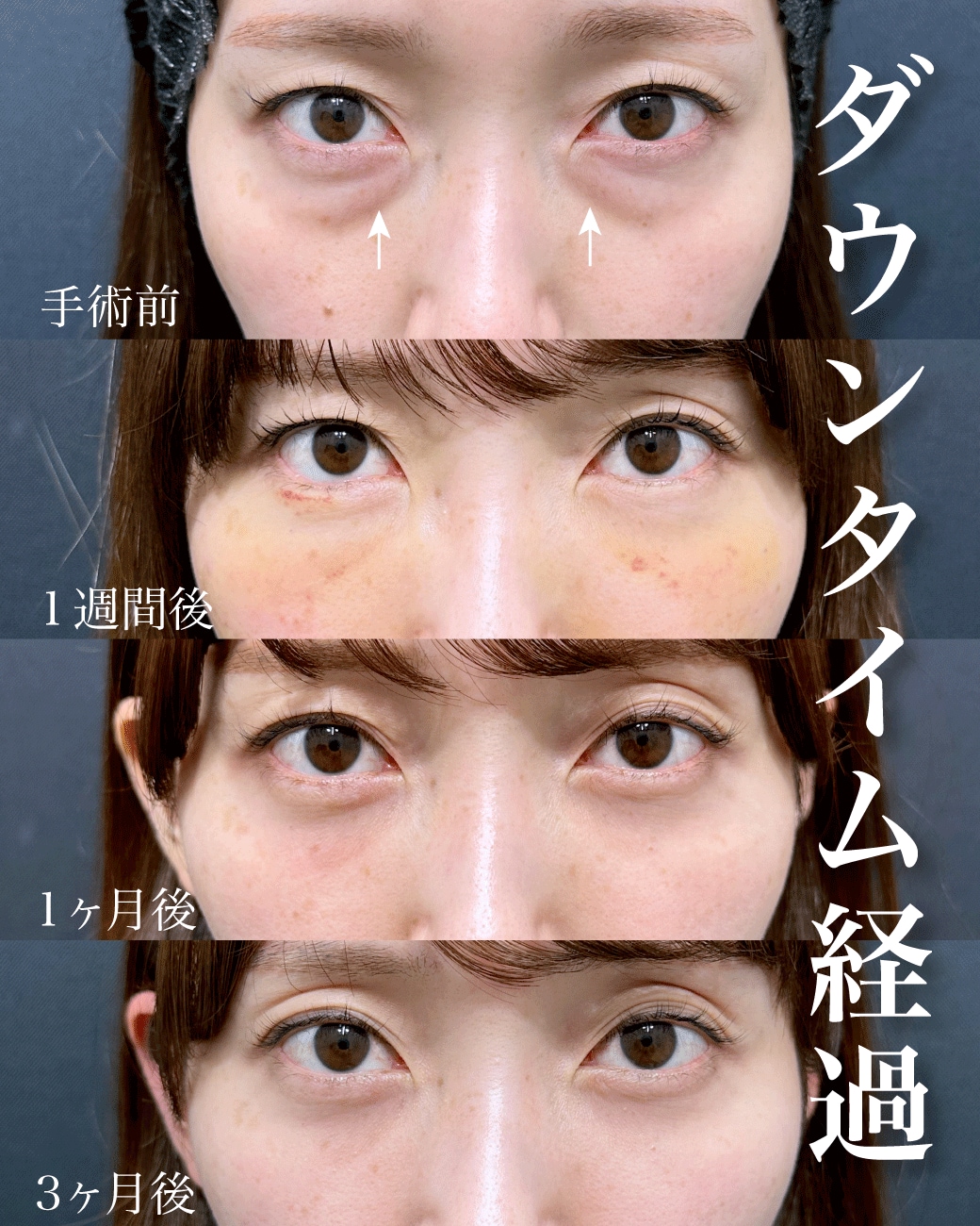 ダウンタイムの一般的な経過
