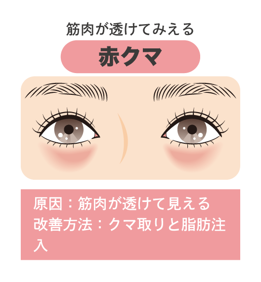 脂肪の圧迫や赤みが透ける「赤クマ」