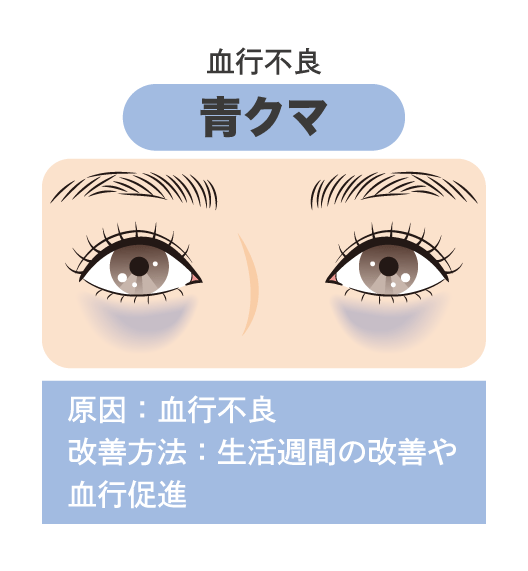 ② 寝不足や疲れで目立つ「青クマ」
