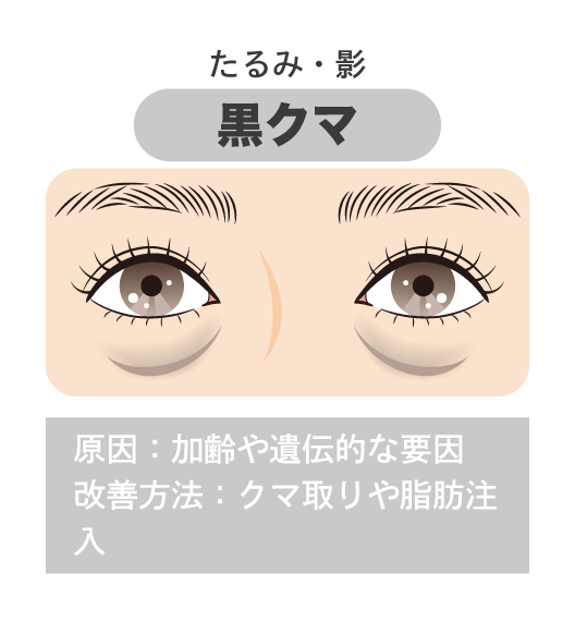 ① 老け見えの主な原因「黒クマ」