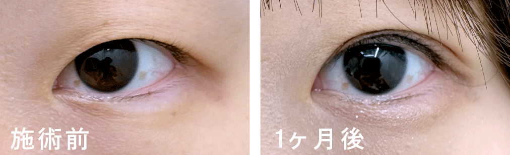 【二重整形・埋没法】でナチュラルなのに華やかな理想の瞳に