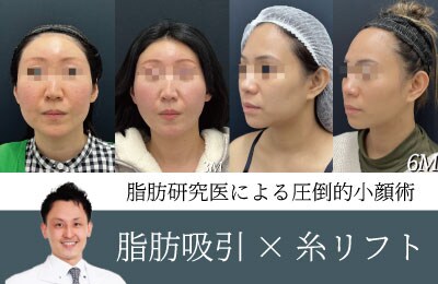 【速攻小顔】脂肪研究医によるオーダーメイドの小顔術