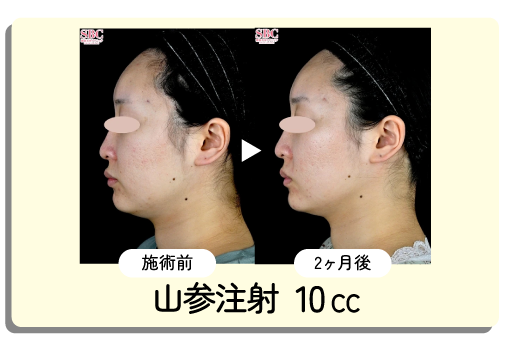 山参注射　10cc