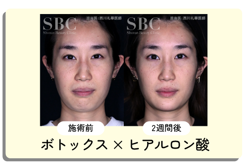 同時施術で10%オフ