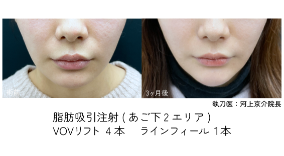 脂肪吸引注射×糸リフト×ヒアルロン酸