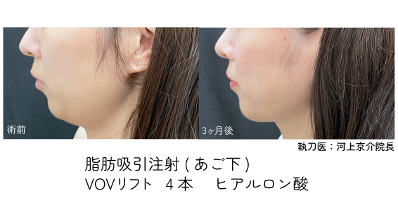 脂肪吸引×糸リフト×ヒアルロン酸