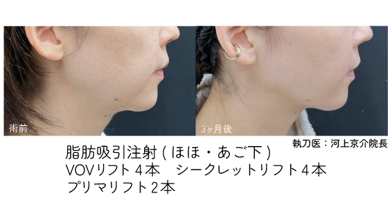 脂肪吸引注射×糸リフト