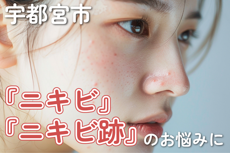 宇都宮でできる『ニキビ』『ニキビ跡』のおすすめ治療