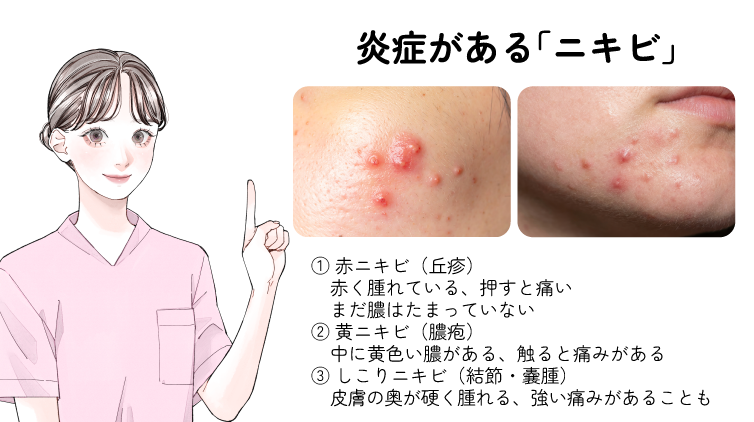 炎症があるニキビにはいくつかの種類があります！<br />
