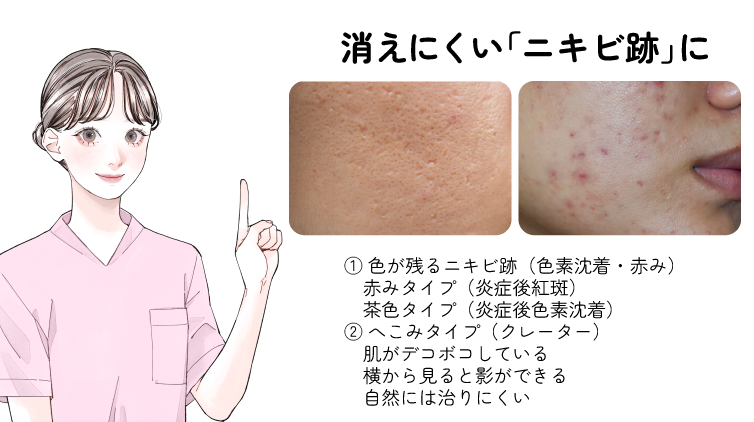 ニキビ後には種類があります！