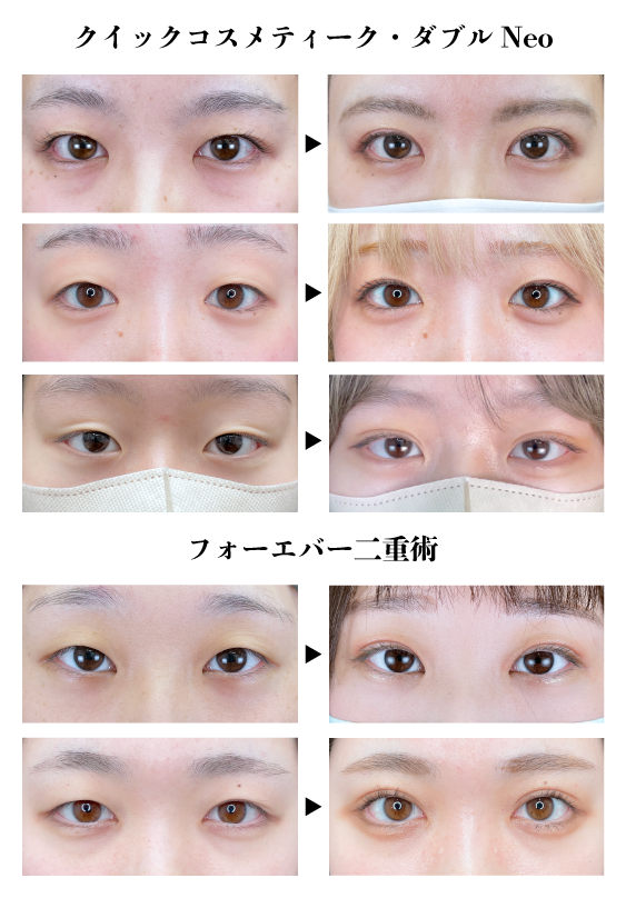 クイックコスメティークダブルNeoとフォーエバー二重術